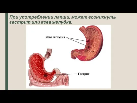 При употреблении лапши, может возникнуть гастрит или язва желудка.