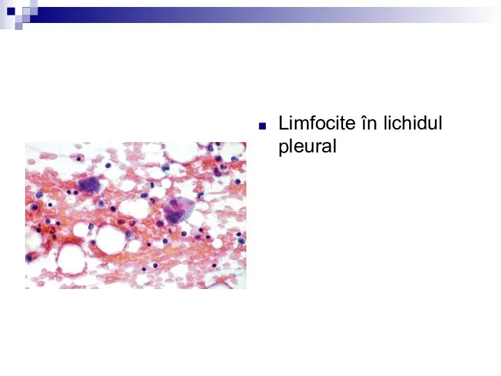 Limfocite în lichidul pleural