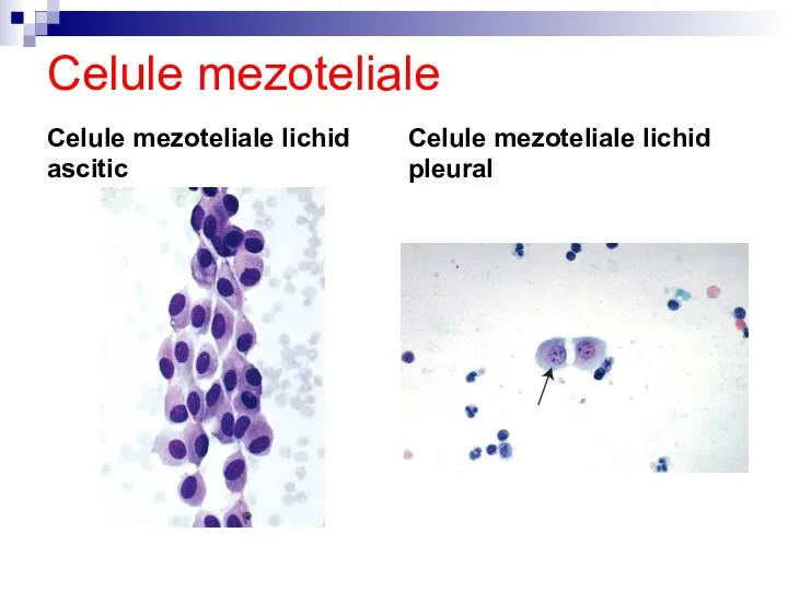 Celule mezoteliale Celule mezoteliale lichid ascitic Celule mezoteliale lichid pleural