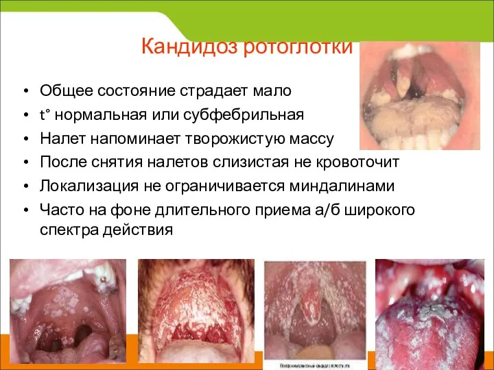 Кандидоз ротоглотки Общее состояние страдает мало t° нормальная или субфебрильная Налет