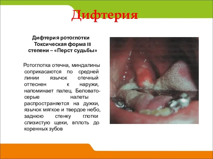 Дифтерия ротоглотки Токсическая форма III степени – «Перст судьбы» Ротоглотка отечна,