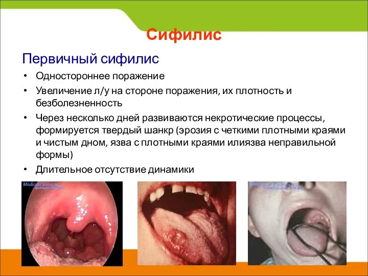 Сифилис Первичный сифилис Одностороннее поражение Увеличение л/у на стороне поражения, их