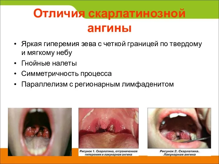 Отличия скарлатинозной ангины Яркая гиперемия зева с четкой границей по твердому