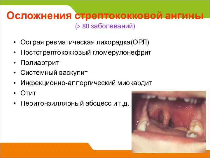 Осложнения стрептококковой ангины (> 80 заболеваний) Острая ревматическая лихорадка(ОРЛ) Постстрептококковый гломерулонефрит