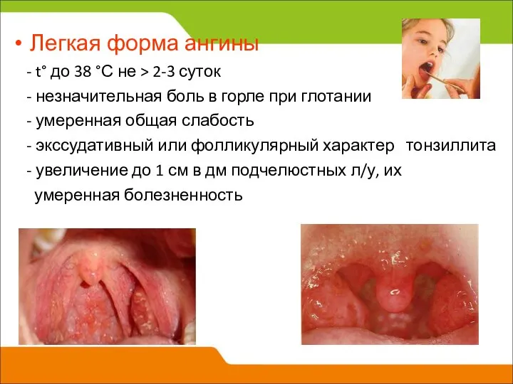 Легкая форма ангины - t° до 38 °С не > 2-3