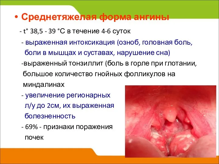 Среднетяжелая форма ангины - t° 38,5 - 39 °С в течение