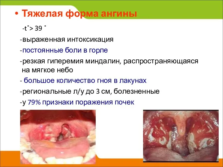 Тяжелая форма ангины -t˚> 39 ˚ -выраженная интоксикация -постоянные боли в