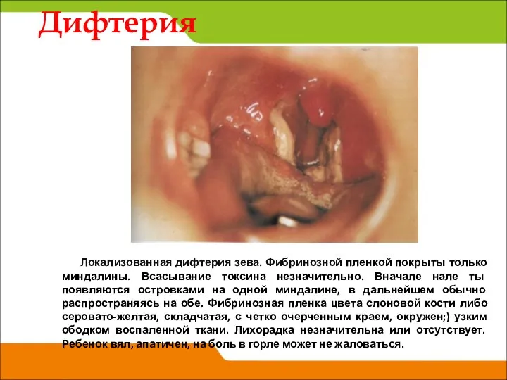 Дифтерия Локализованная дифтерия зева. Фибринозной пленкой покрыты только миндалины. Всасывание токсина