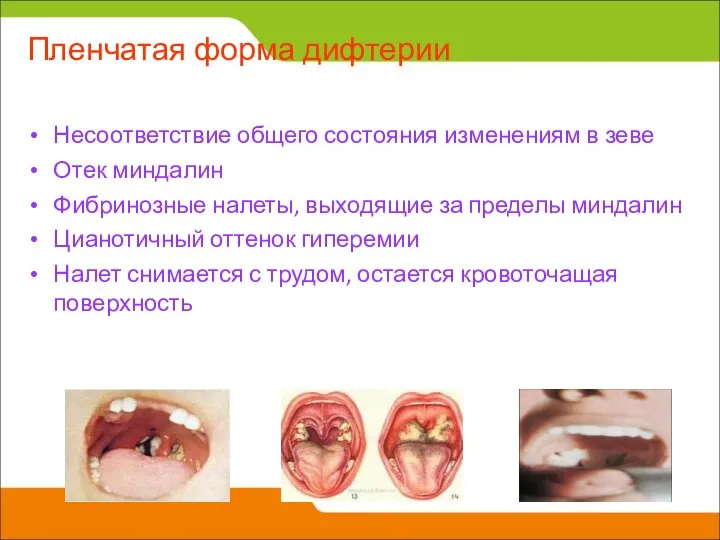 Пленчатая форма дифтерии Несоответствие общего состояния изменениям в зеве Отек миндалин