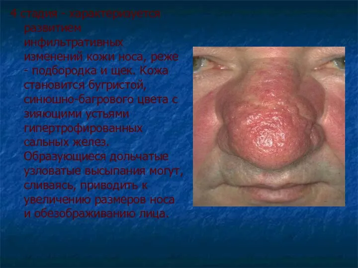 4 стадия - характеризуется развитием инфильтративных изменений кожи носа, реже -
