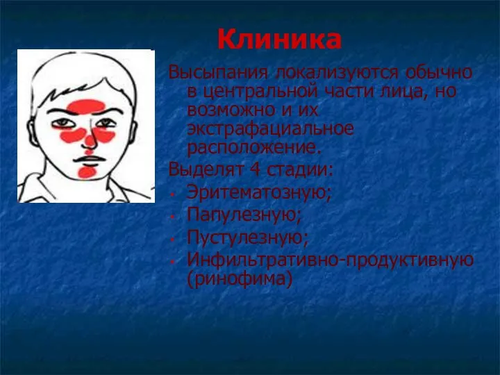 Клиника Высыпания локализуются обычно в центральной части лица, но возможно и