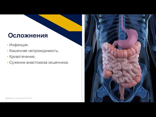 Инфекция. Кишечная непроходимость. Кровотечение. Сужение анастомоза кишечника. Осложнения Добавить нижний колонтитул