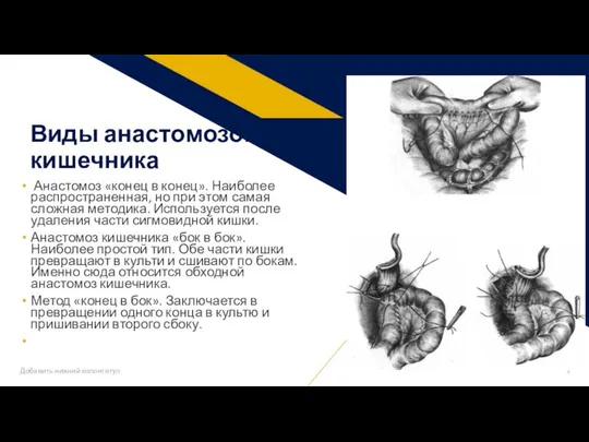 Анастомоз «конец в конец». Наиболее распространенная, но при этом самая сложная