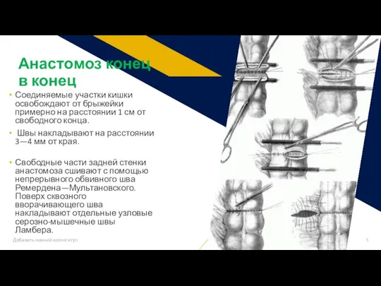 Соединяемые участки кишки освобождают от брыжейки примерно на расстоянии 1 см