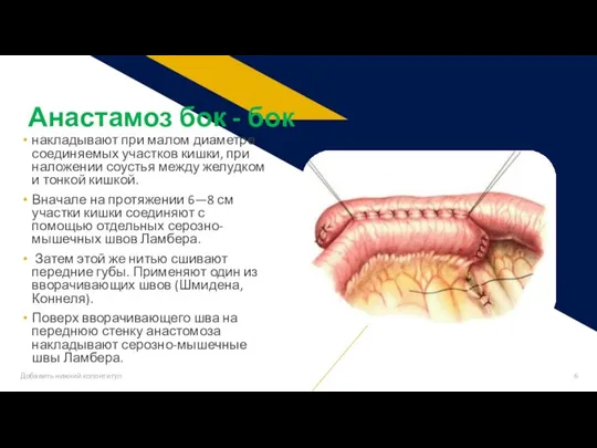 накладывают при малом диаметре соединяемых участков кишки, при наложении соустья между