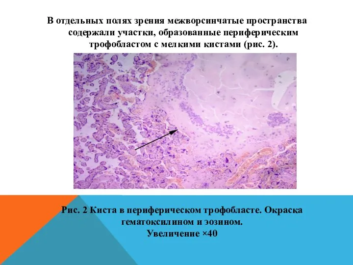 В отдельных полях зрения межворсинчатые пространства содержали участки, образованные периферическим трофобластом