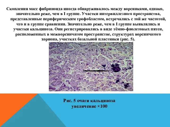 Скопления масс фибриноида иногда обнаруживалось между ворсинками, однако, значительно реже, чем