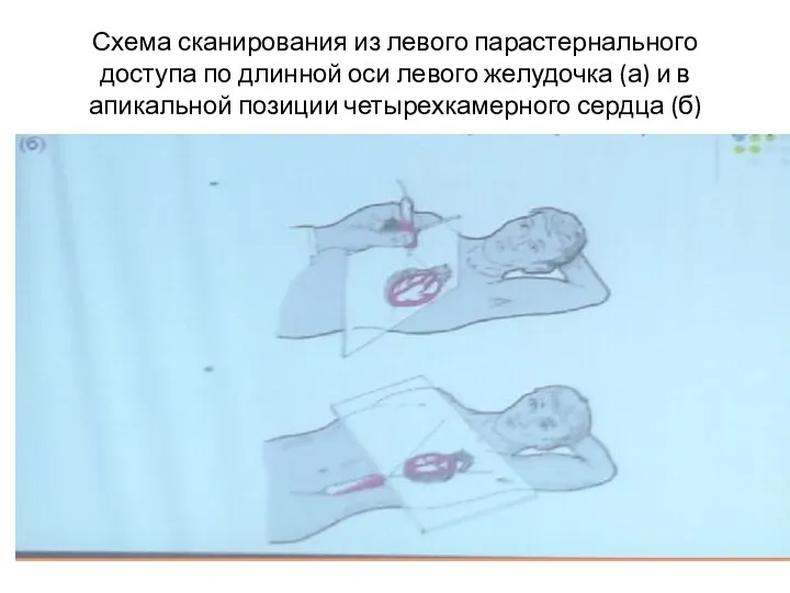 Схема сканирования из левого парастернального доступа по длинной оси левого желудочка