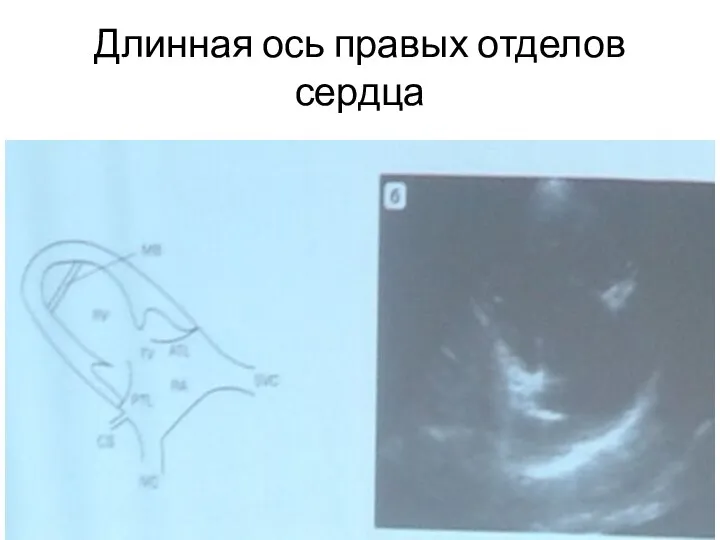 Длинная ось правых отделов сердца