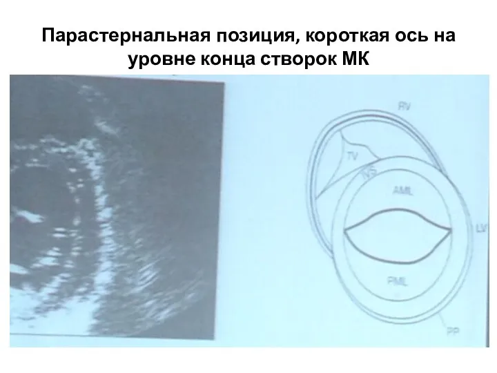 Парастернальная позиция, короткая ось на уровне конца створок МК