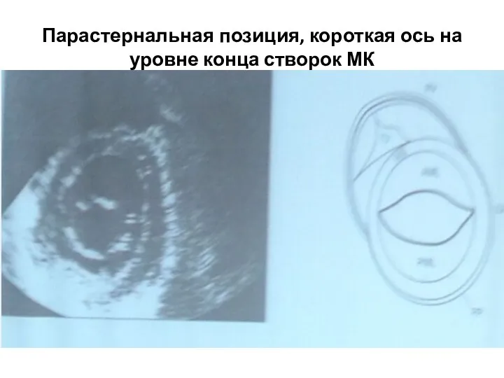 Парастернальная позиция, короткая ось на уровне конца створок МК