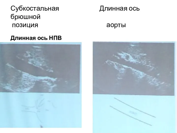 Субкостальная Длинная ось брюшной позиция аорты Длинная ось НПВ