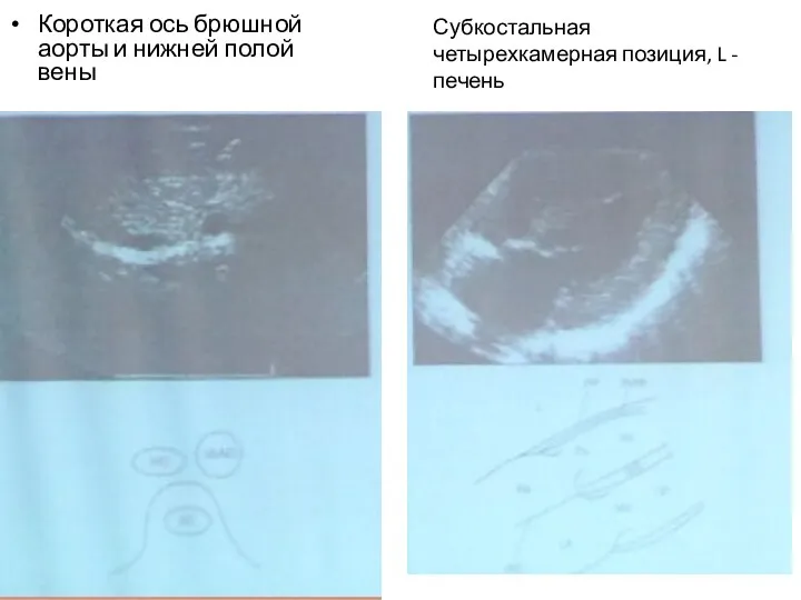 Короткая ось брюшной аорты и нижней полой вены Субкостальная четырехкамерная позиция, L - печень