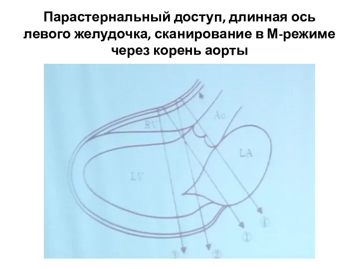 Парастернальный доступ, длинная ось левого желудочка, сканирование в М-режиме через корень аорты