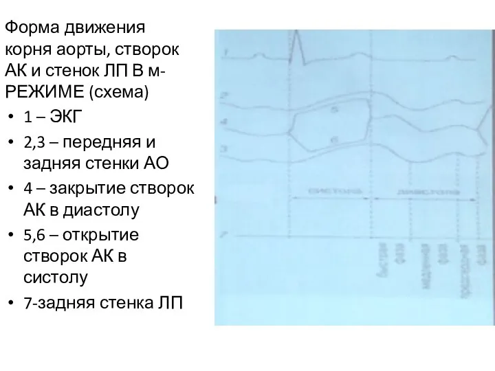 Форма движения корня аорты, створок АК и стенок ЛП В м-РЕЖИМЕ