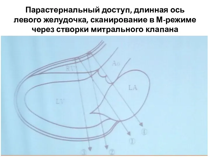 Парастернальный доступ, длинная ось левого желудочка, сканирование в М-режиме через створки митрального клапана