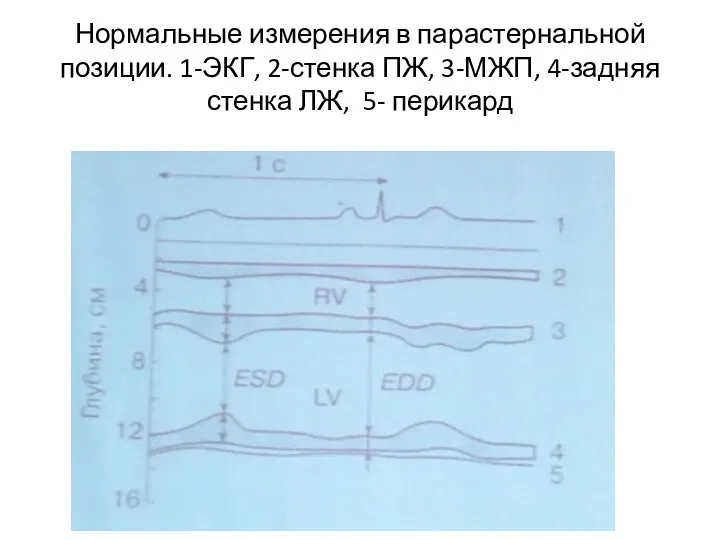 Нормальные измерения в парастернальной позиции. 1-ЭКГ, 2-стенка ПЖ, 3-МЖП, 4-задняя стенка ЛЖ, 5- перикард