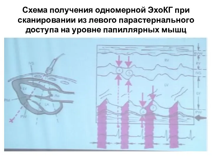 Схема получения одномерной ЭхоКГ при сканировании из левого парастернального доступа на уровне папиллярных мышц