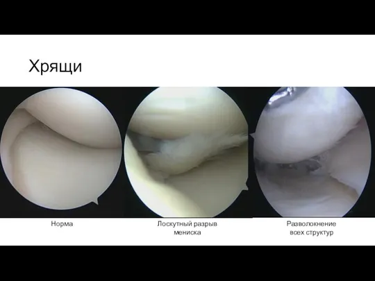 Хрящи Норма Лоскутный разрыв мениска Разволокнение всех структур