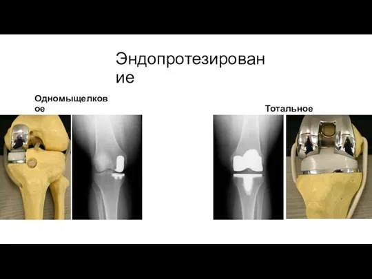 Эндопротезирование Одномыщелковое Тотальное