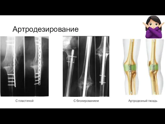 Артродезирование С блокированием Артродезный гвоздь С пластиной