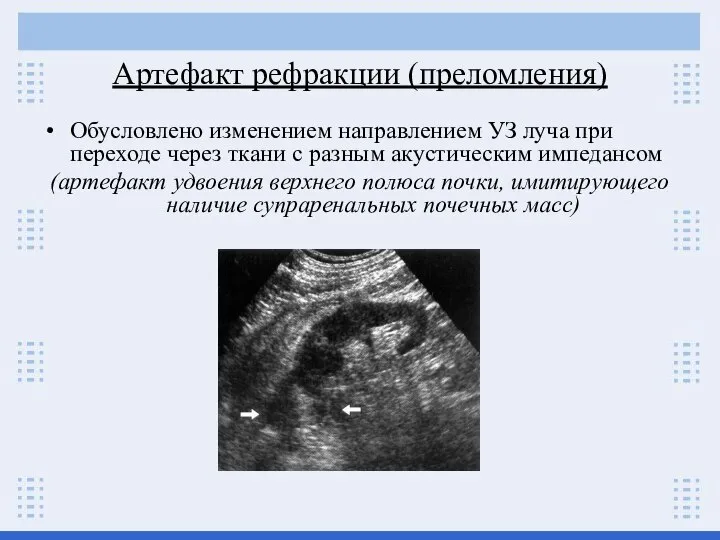 Артефакт рефракции (преломления) Обусловлено изменением направлением УЗ луча при переходе через