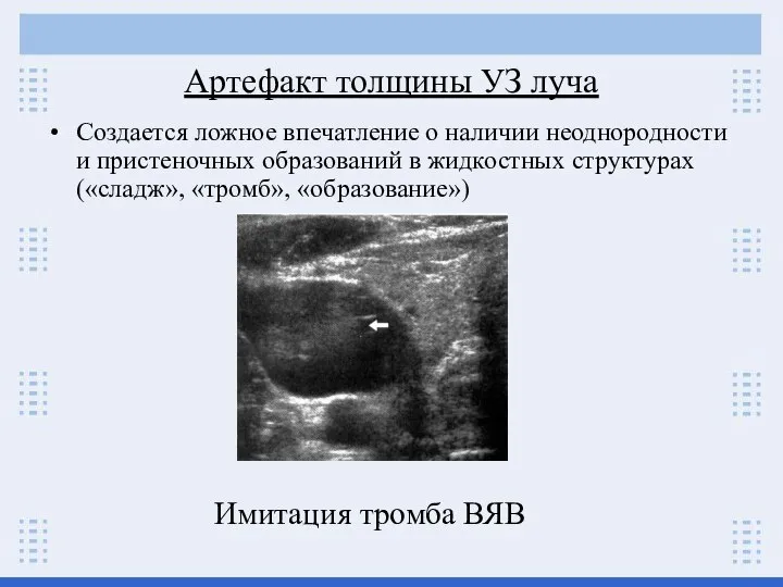 Артефакт толщины УЗ луча Создается ложное впечатление о наличии неоднородности и