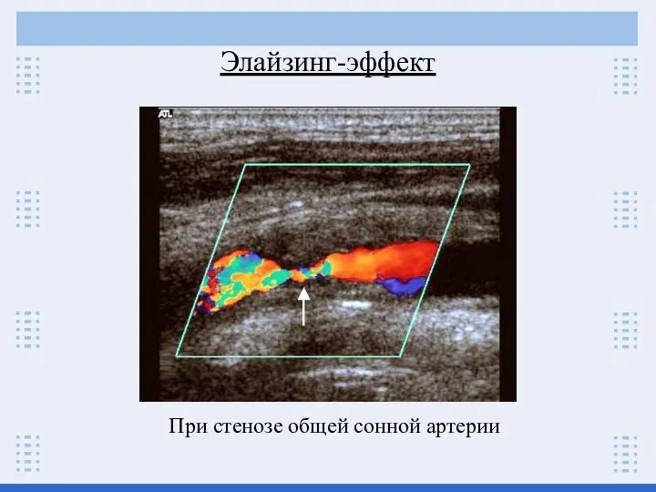 Элайзинг-эффект При стенозе общей сонной артерии