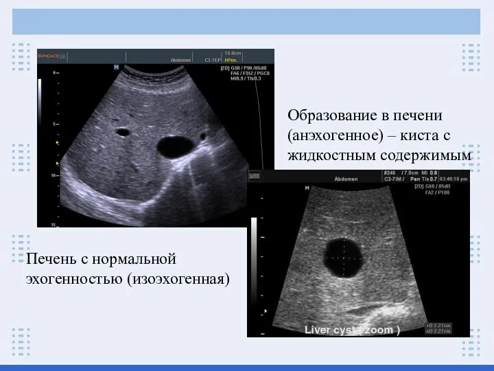 Печень с нормальной эхогенностью (изоэхогенная) Образование в печени (анэхогенное) – киста с жидкостным содержимым
