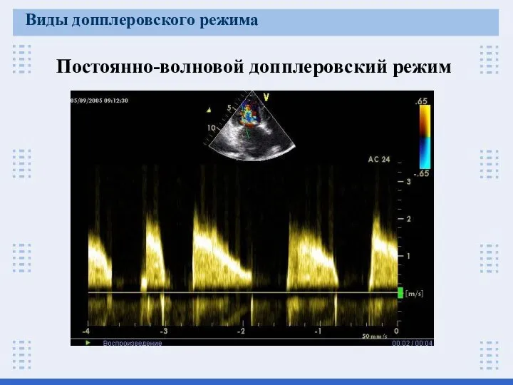 Постоянно-волновой допплеровский режим Виды допплеровского режима