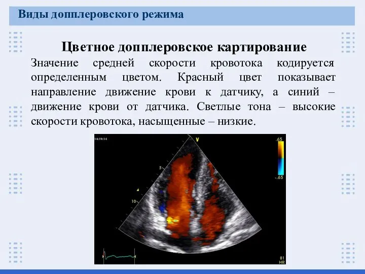 Цветное допплеровское картирование Значение средней скорости кровотока кодируется определенным цветом. Красный