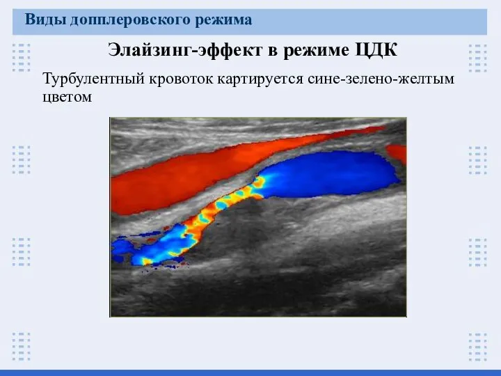 Элайзинг-эффект в режиме ЦДК Турбулентный кровоток картируется сине-зелено-желтым цветом Виды допплеровского режима