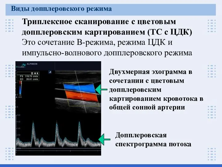 Триплексное сканирование с цветовым допплеровским картированием (ТС с ЦДК) Это сочетание