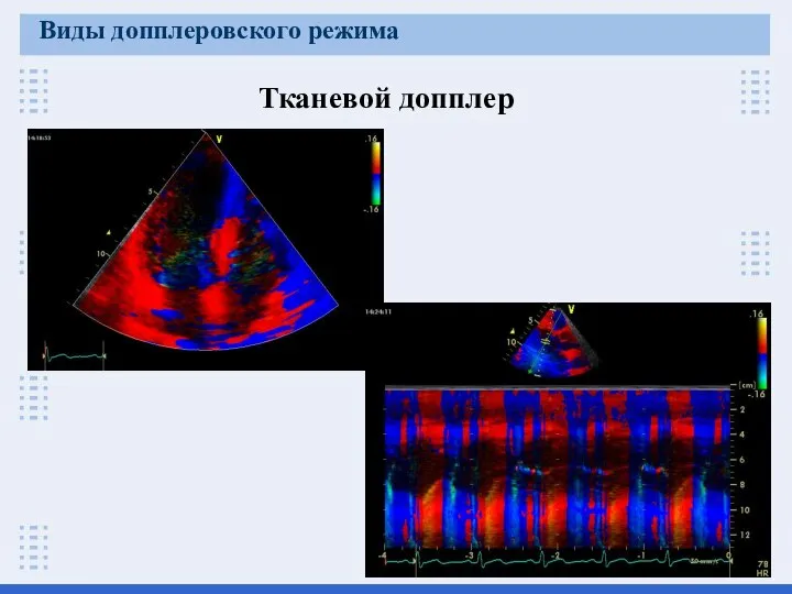 Тканевой допплер Виды допплеровского режима