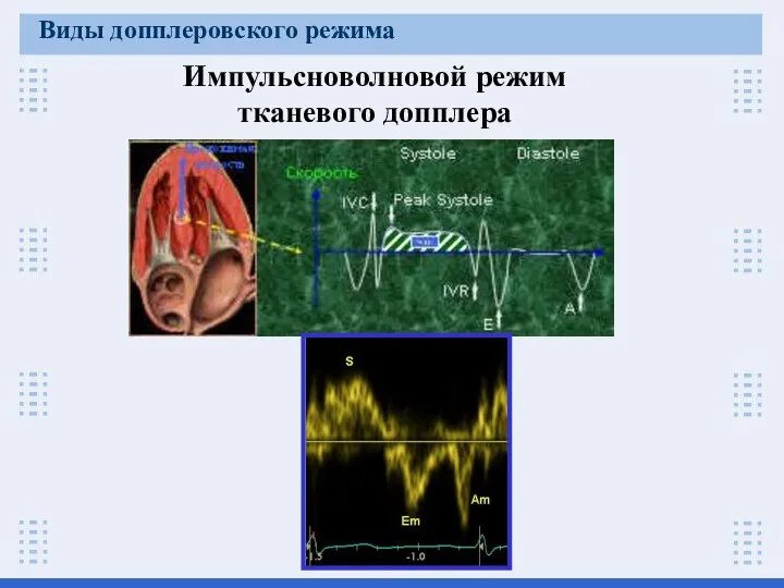 Импульсноволновой режим тканевого допплера Виды допплеровского режима