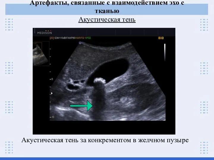 Артефакты, связанные с взаимодействием эхо с тканью Акустическая тень Акустическая тень за конкрементом в желчном пузыре