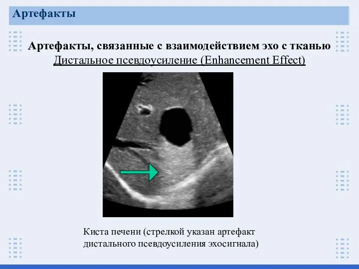 Артефакты, связанные с взаимодействием эхо с тканью Дистальное псевдоусиление (Enhancement Effect) Артефакты