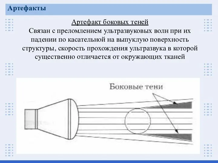 Артефакт боковых теней Связан с преломлением ультразвуковых волн при их падении