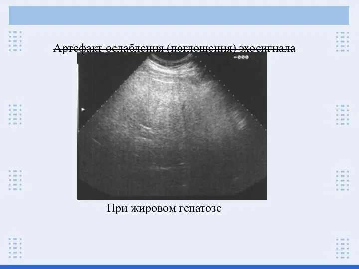 Артефакт ослабления (поглощения) эхосигнала При жировом гепатозе