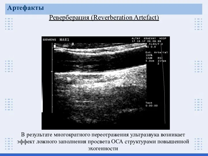 Реверберация (Reverberation Artefact) В результате многократного переотражения ультразвука возникает эффект ложного